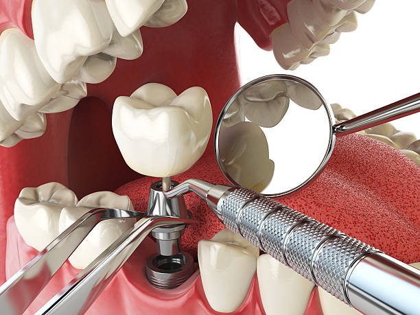 Best Emergency Tooth Extraction in Spanish Springs, NV